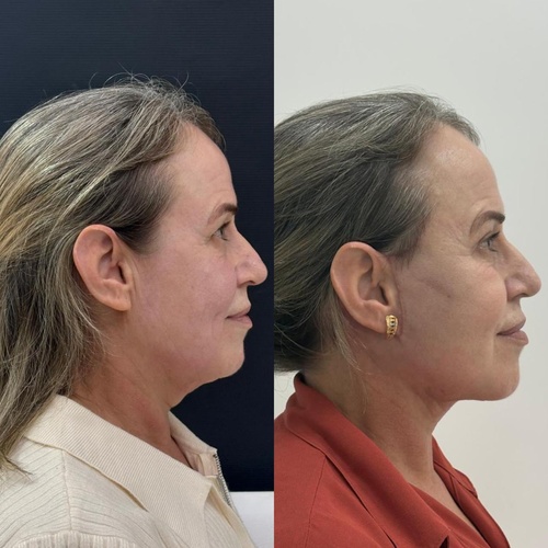 Caso Clínico 4 Antes e Depois
