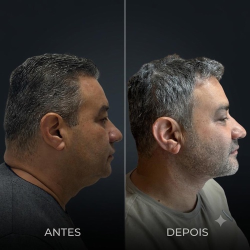 Caso Clínico 5 Antes e Depois